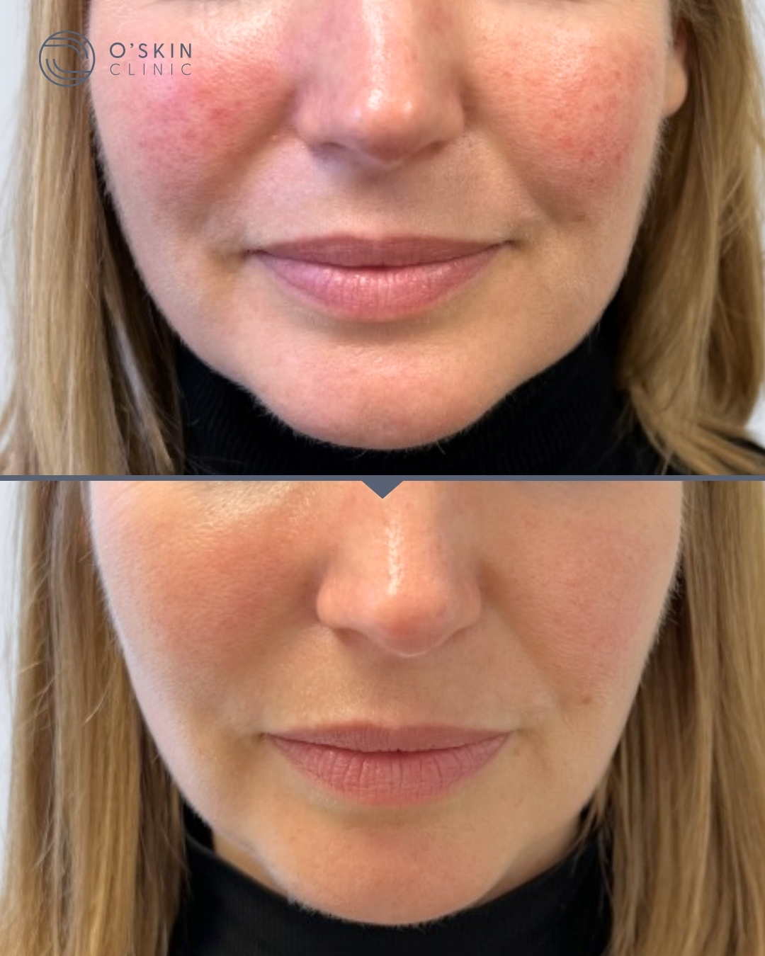 rosacea før efter behandling