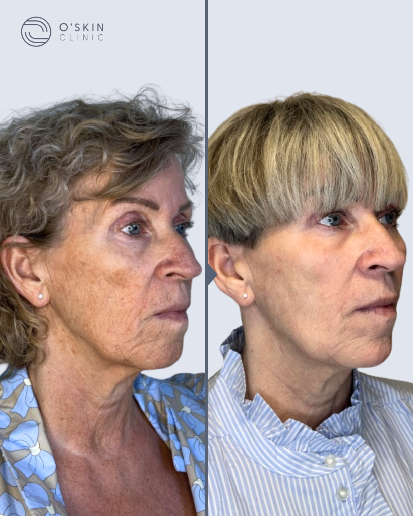 Før og efter CO2 laserbehandling af rynker hos O'Skin Clinic