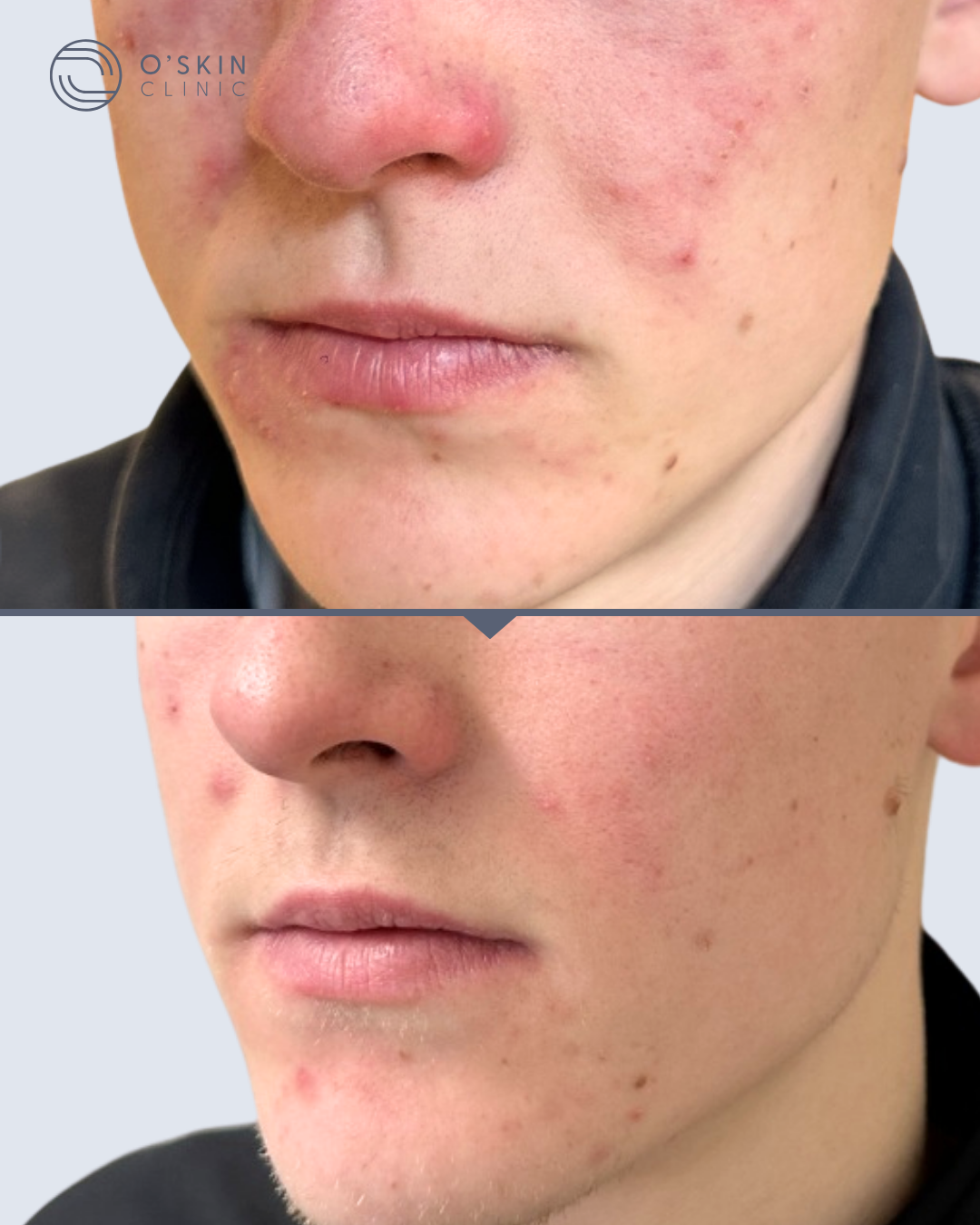 Rosacea før efter