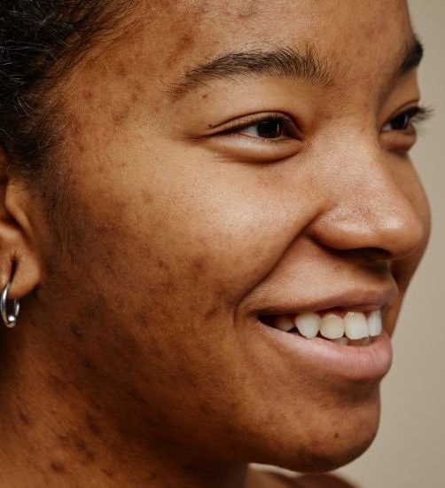 Akne stockbillede. Akne behandling. Kur mod bumser.