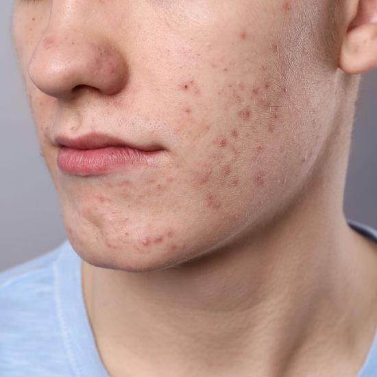 akne og urenheder akne i ansigtet. Uren hud behandling