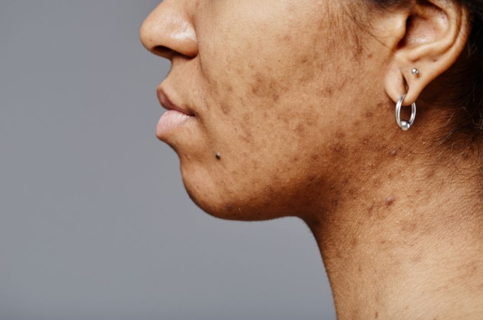 behandling for akne og aknear. Kolding