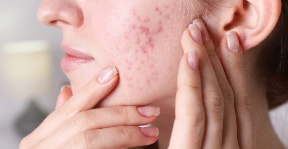 akne. bumser. voksen akne behandling i Kolding. aknear Kolding