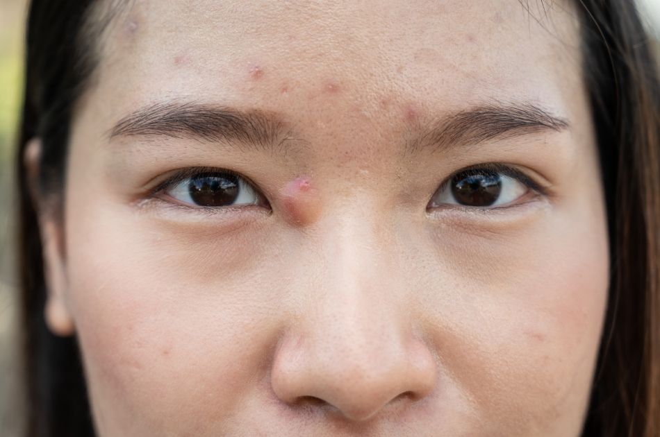 cystisk akne 2 cystisk akne. behandling i Kolding