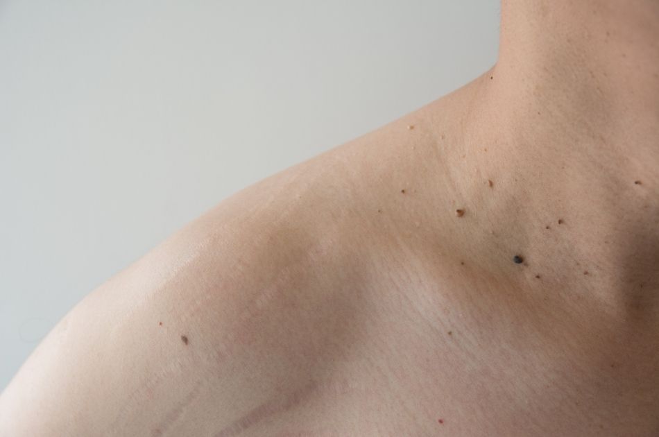 gammelmandsvorter og heksevorter kan fjernes