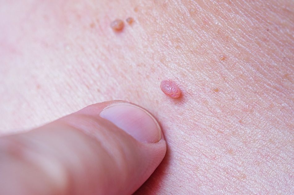 heksevorte skin tags keratose