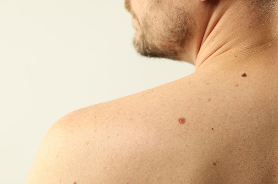 gammelmandsvorter og pletter kan fjernes. Heksevorter kan også fjernes