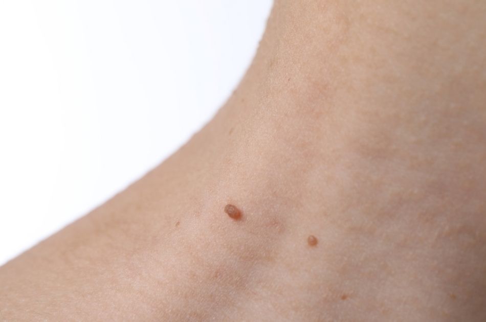 heksevorter og skin tags