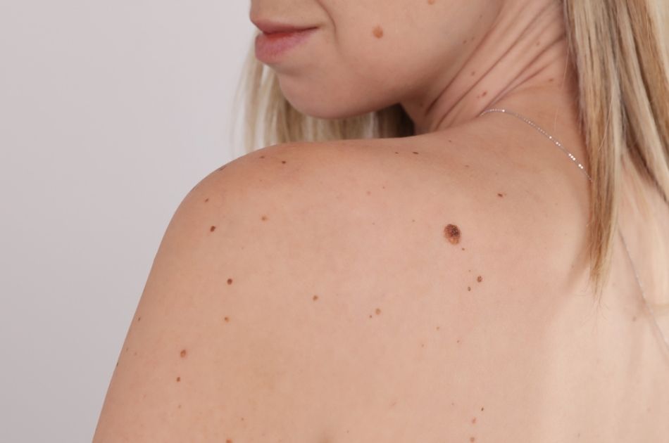 Gammelmandsvorter og gevækster kan fjernes skånsomt og effektivt hos O'skin Clinic