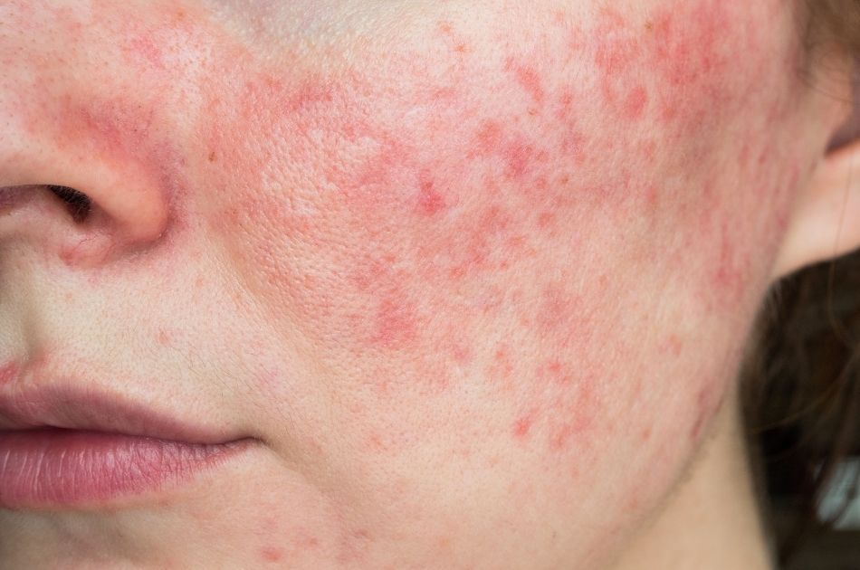 Viden om rosacea. Info om behandling af rosacea. O'Skin Clinic Kolding.