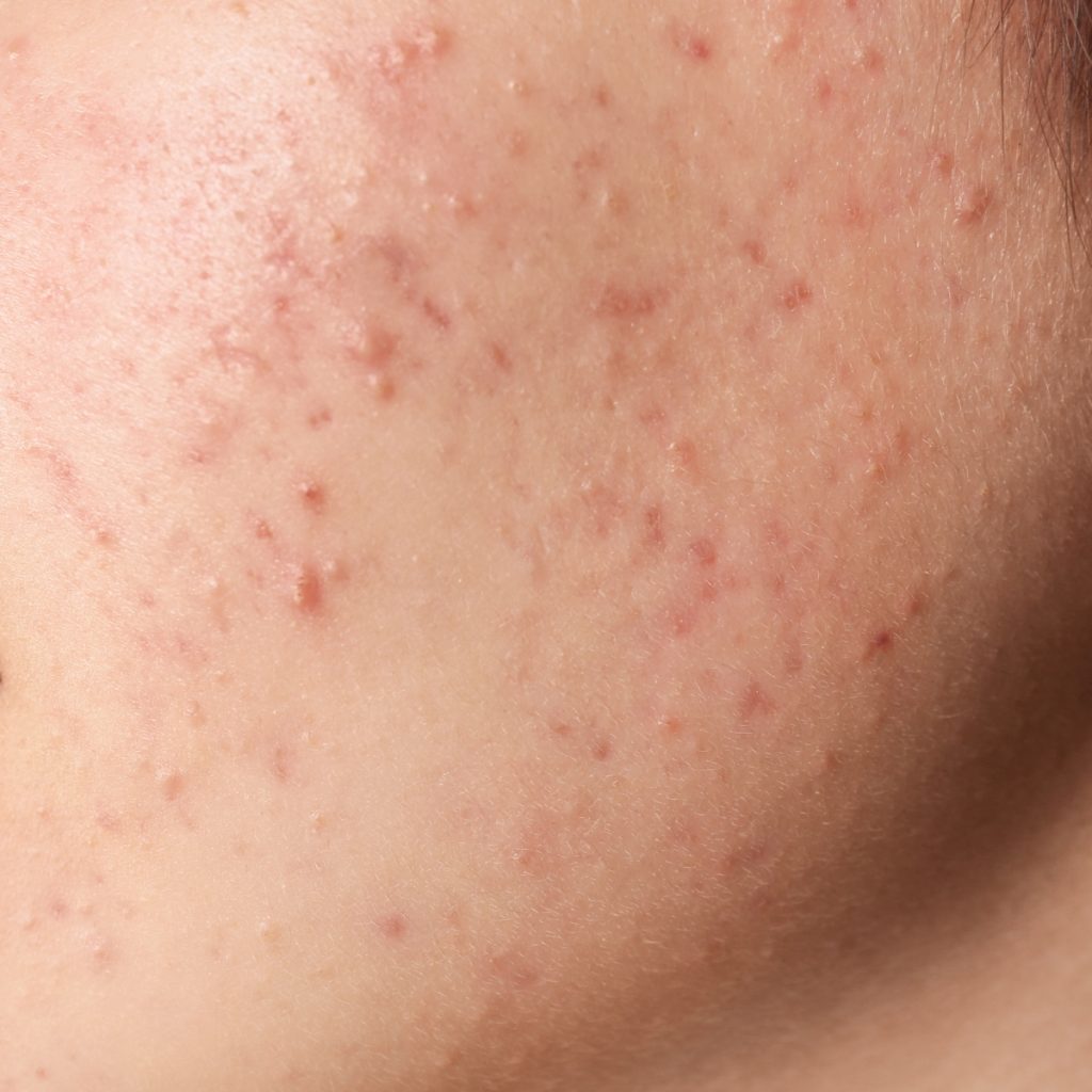 akne og uren hud kemisk peeling