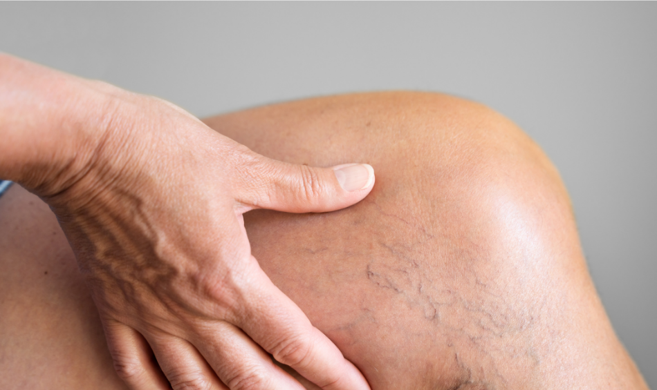 Karsprængninger på ben. O'Skin Clinic Kolding