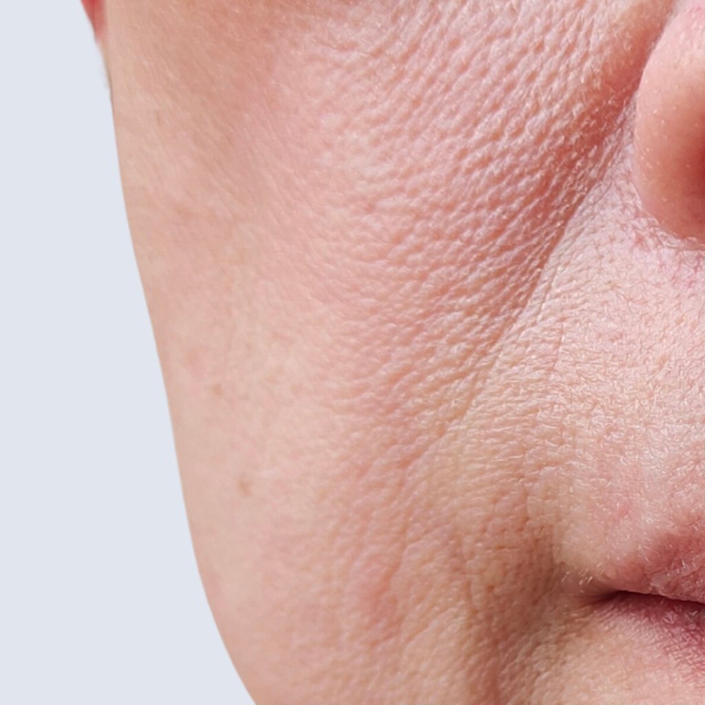 grov hudstruktur kemisk peeling