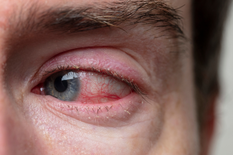 37 rosacea øjne Rosacea øjne inflammation. Okular rosacea. O'Skin Clinic Kolding