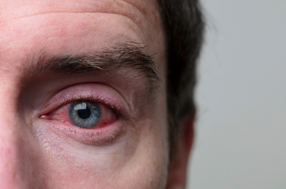 rosacea øjne