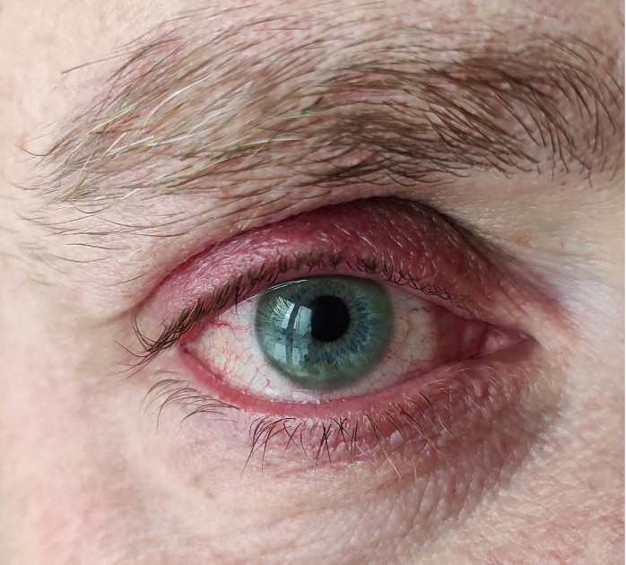 39 øjen rosacea Øjen rosacea. Okular rosacea. O'Skin Clinic Kolding