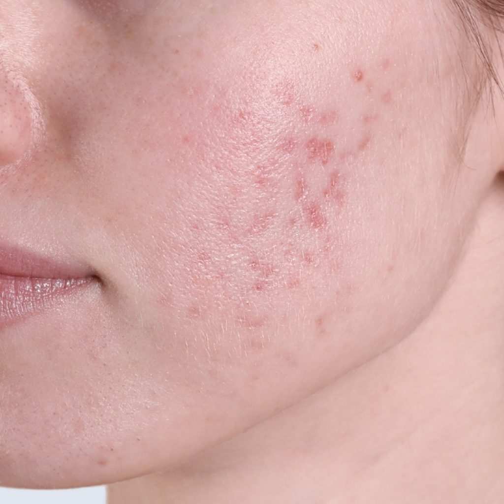 PIE (Post Inflammatory Erythema) kemisk peeling
