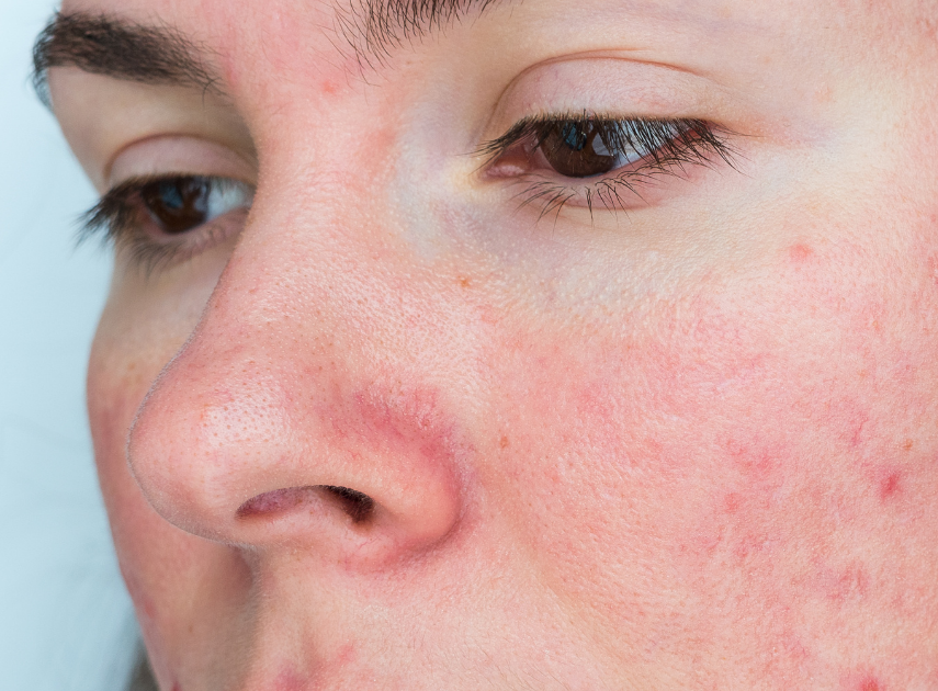 5 rødme og rosacea rosacea og rødme i ansigtet. O'Skin Clinic Kolding