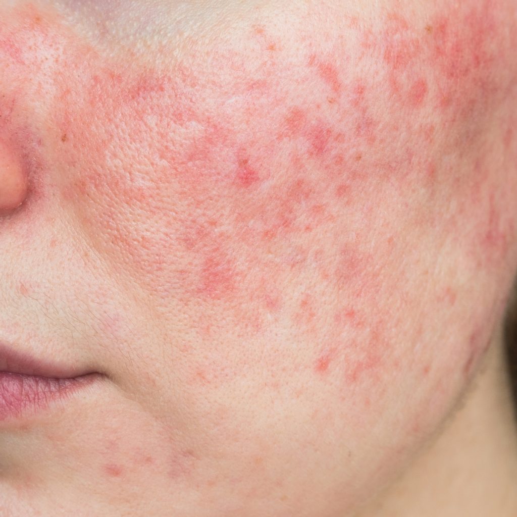 rosacea og rødme kemisk peeling
