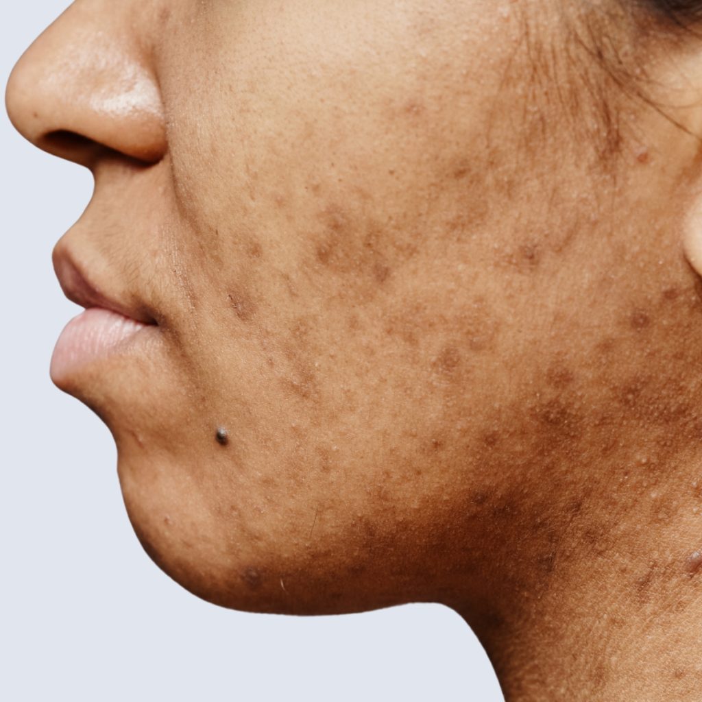 PIH (Post Inflammatory Hyperpigmentation)