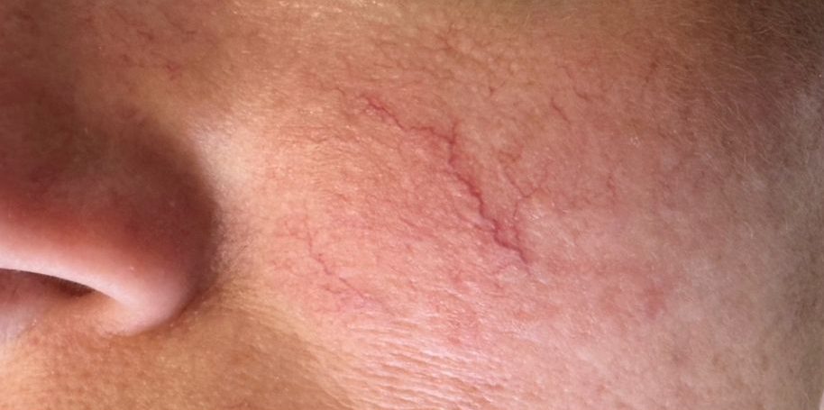 Før & Efter-29 Karsprængninger i ansigtet. Karsprængninger kan behandles ved O'Skin Clinic i Kolding