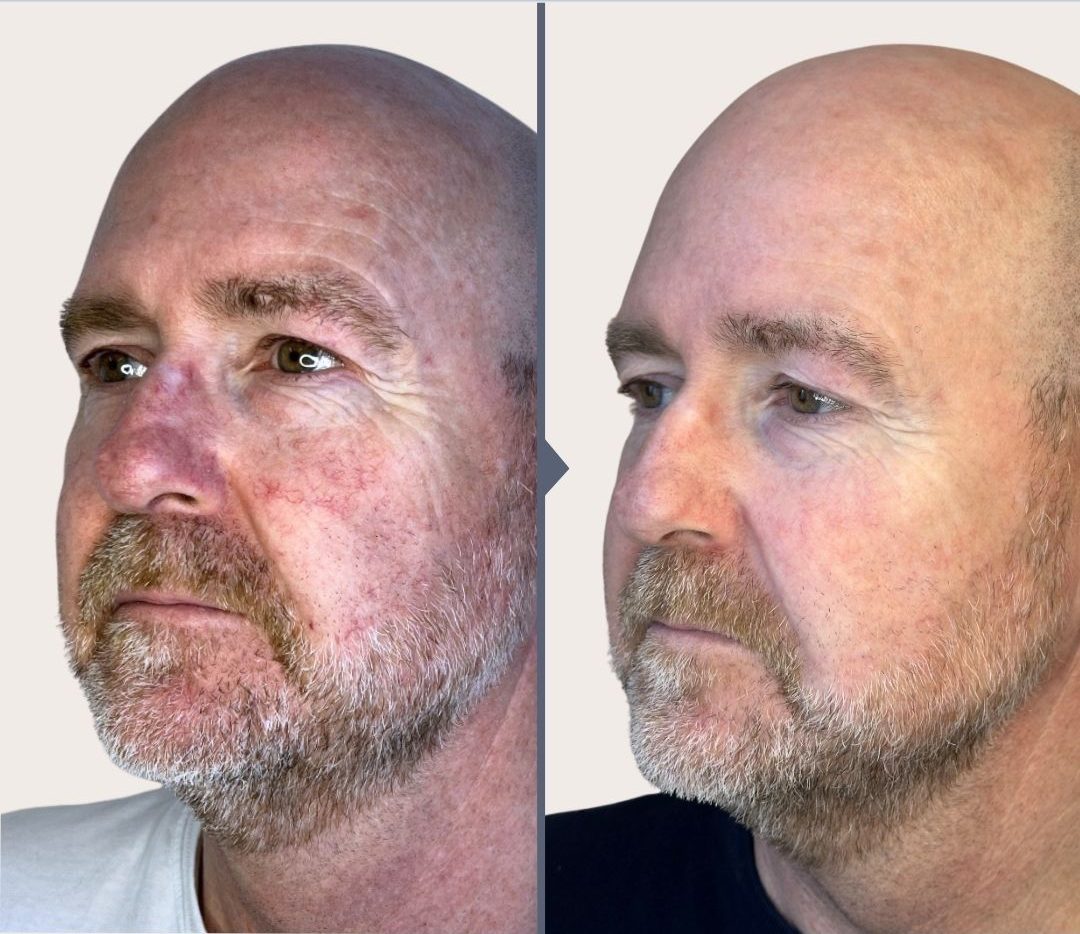 før og efter billede efter behandling af karsprængninger. O'Skin Clinic Kolding