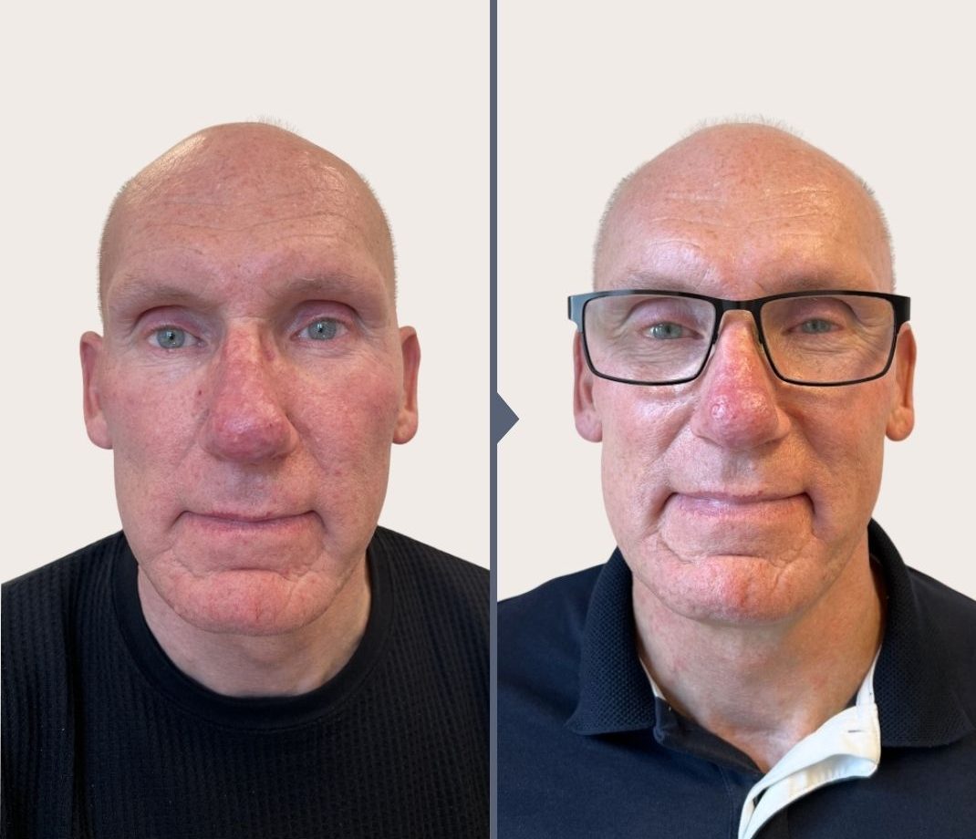 før og efter billede efter behandlings af karprængninger og rhinophyma. O'Skin Clinic Kolding