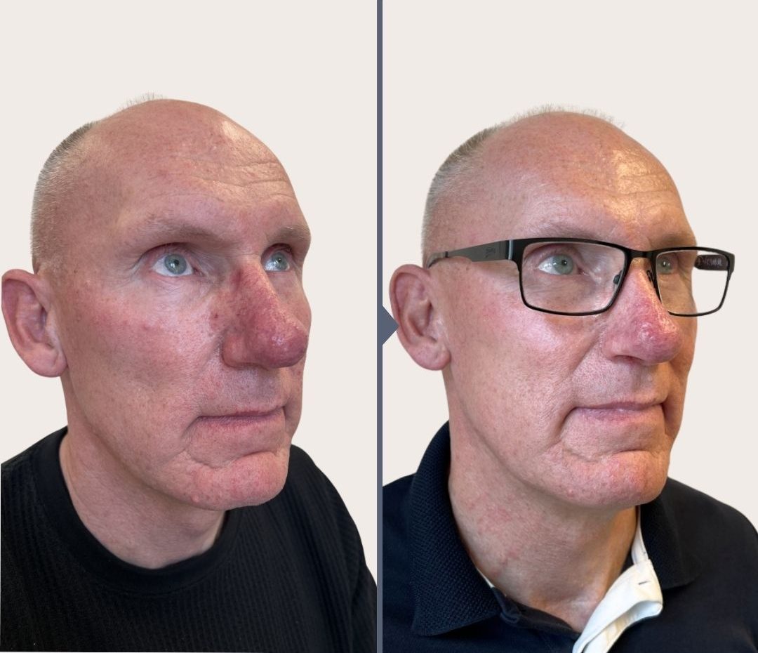 behandling af rosacea næse rhinophyma. O'Skin clinic Kolding