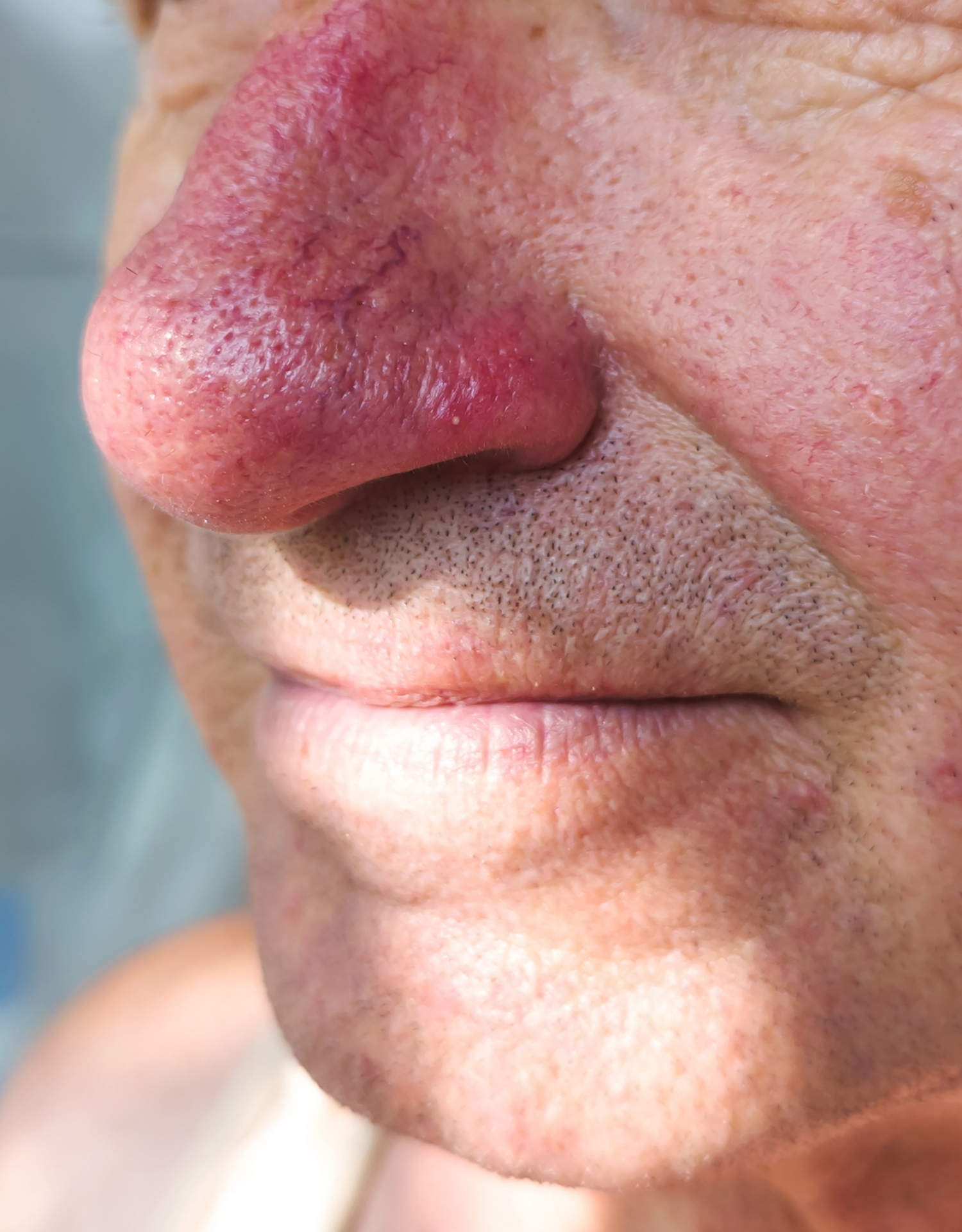 rosacea næse rhinophyma