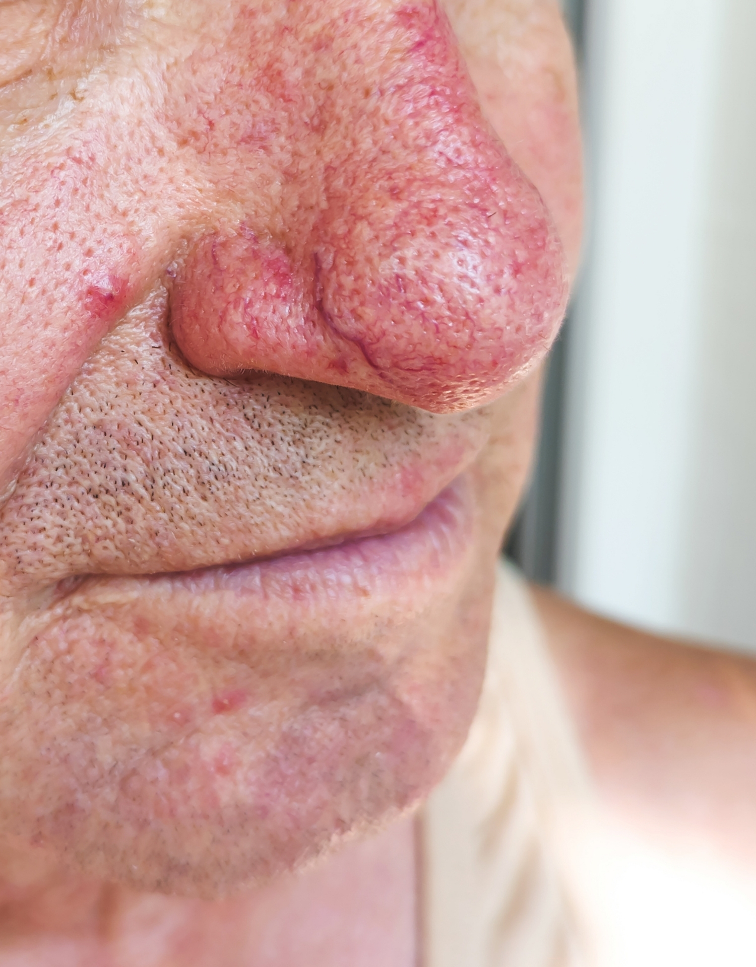 rhinophyma rosacea næse