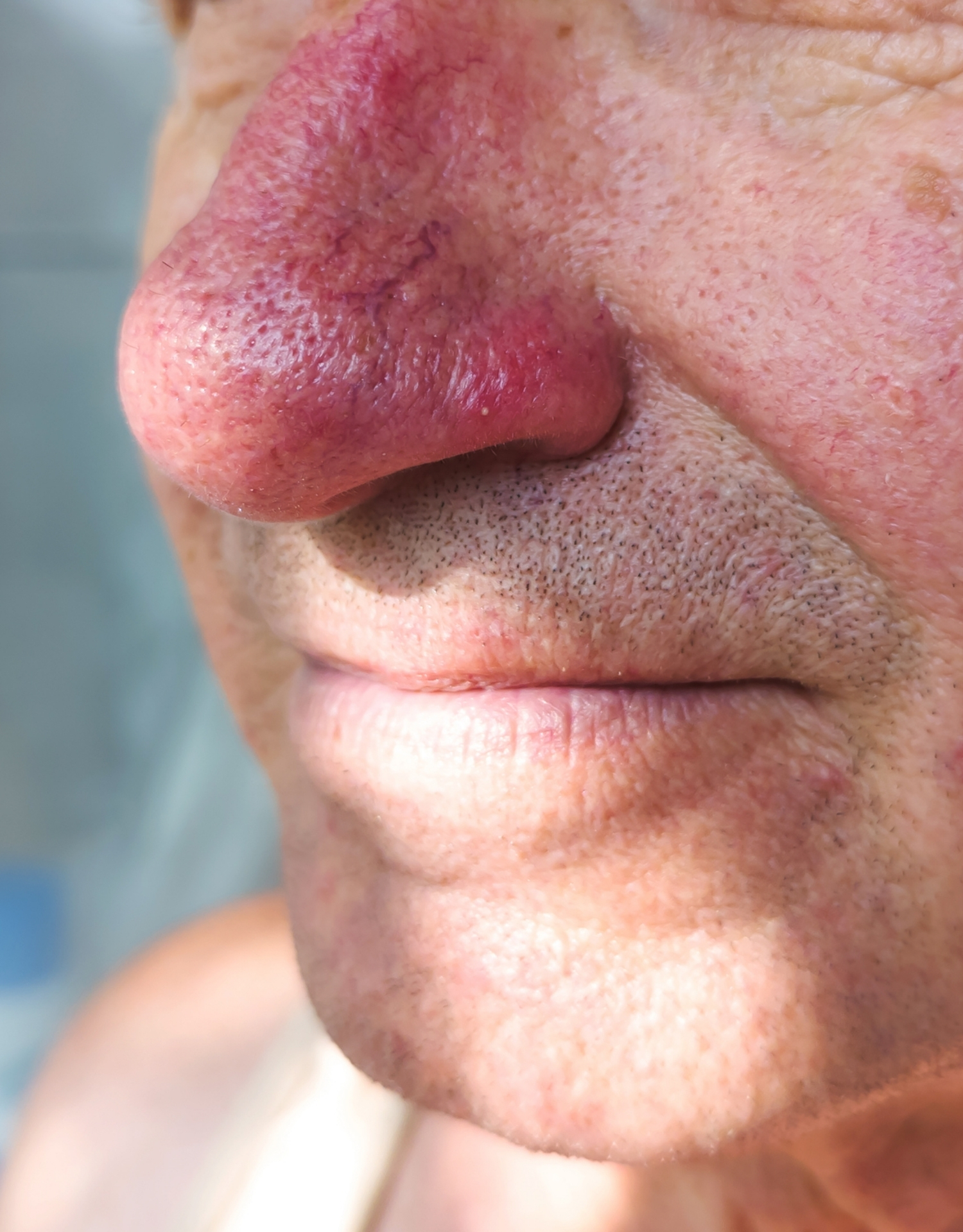 rosacea næse rhinophyma