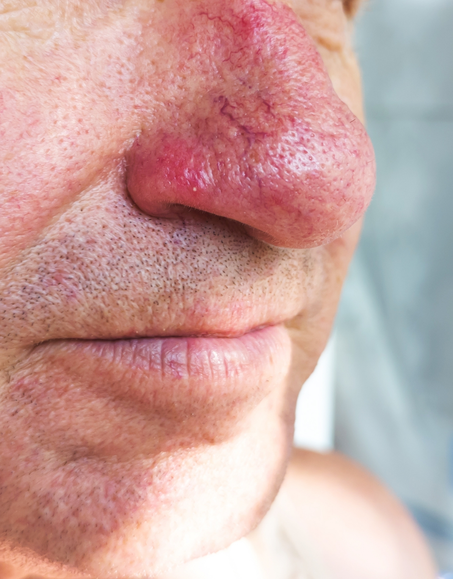 rosacea næse