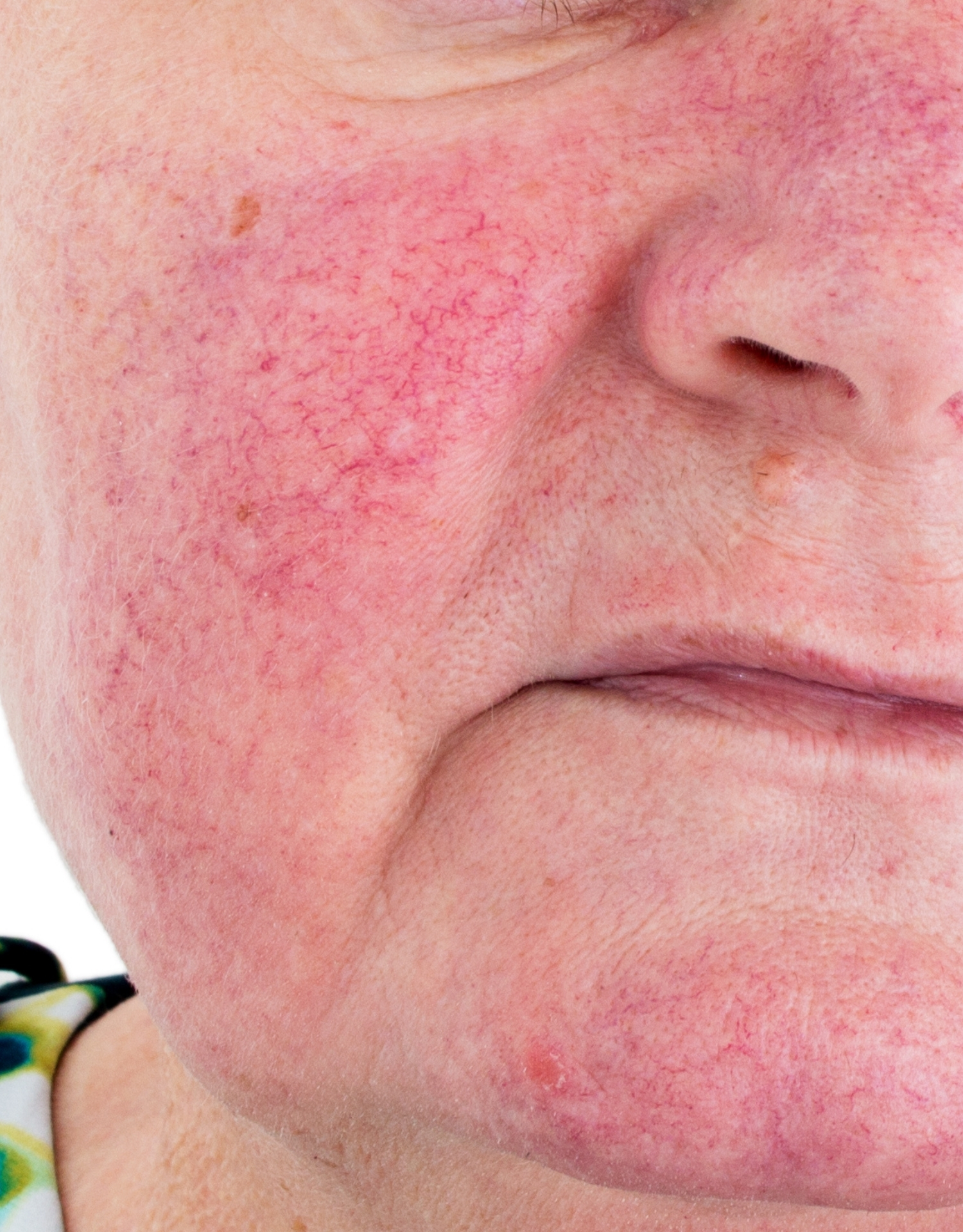 rosacea karsprægninger rødme