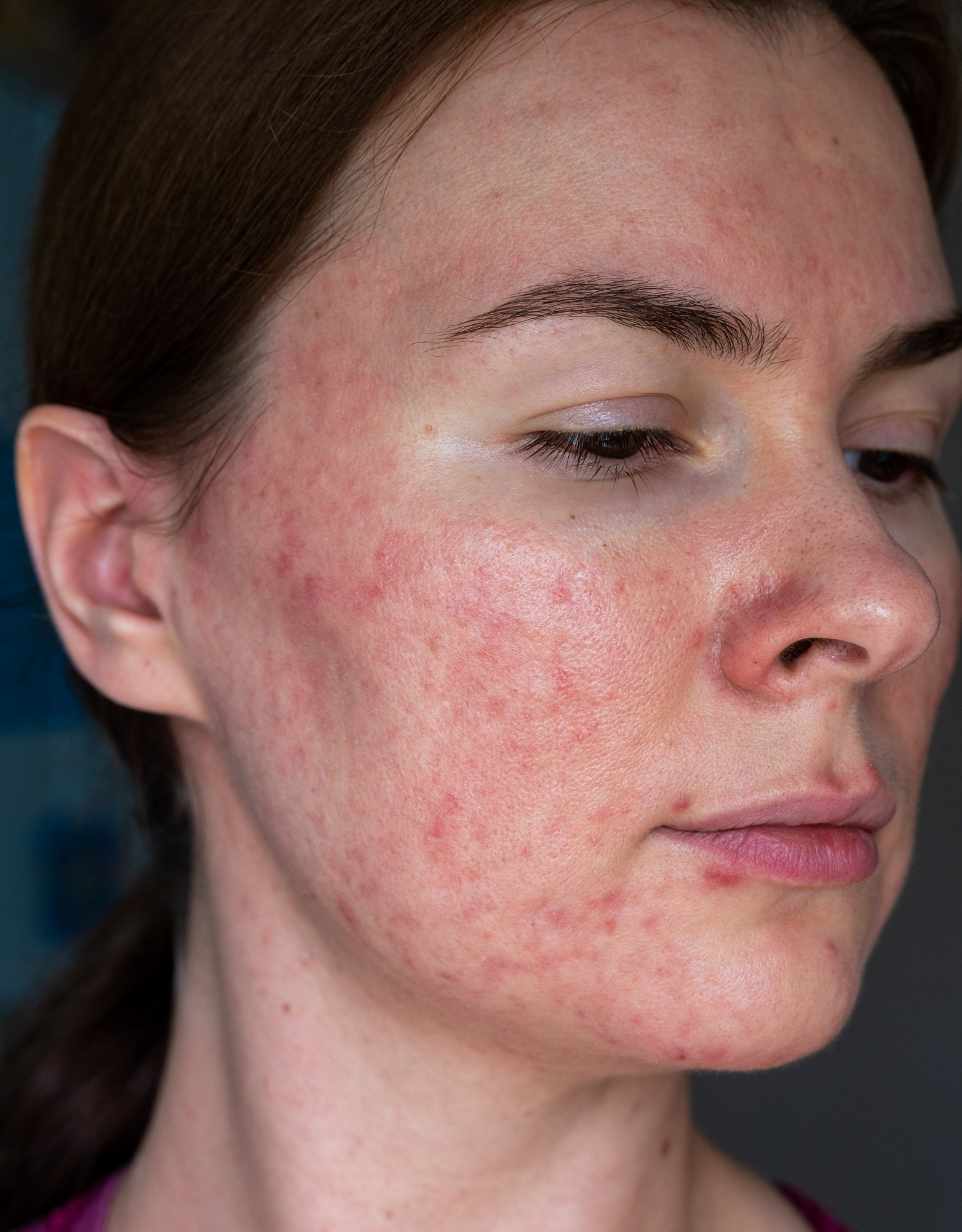 rosacea svær grad