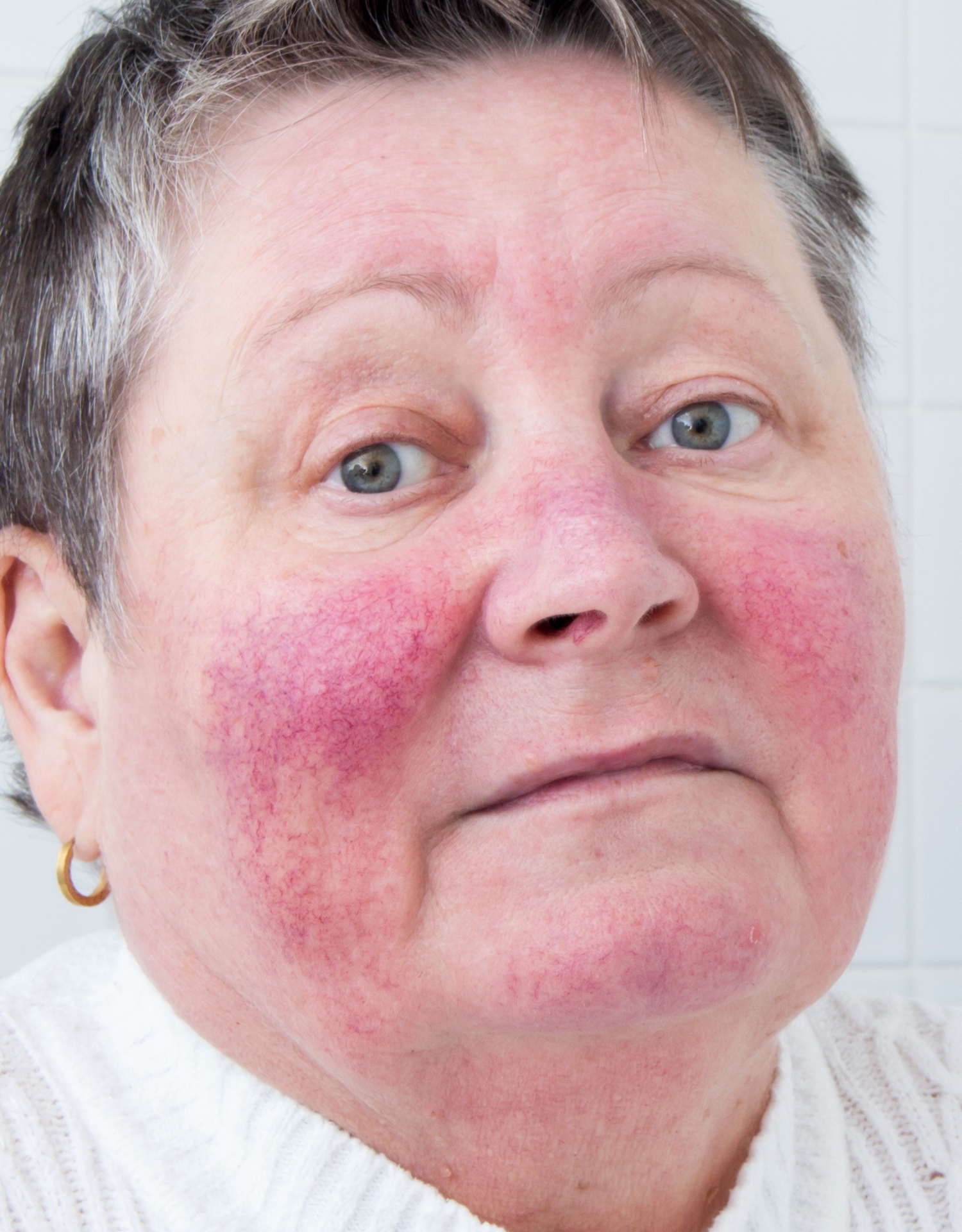 rosacea rødme og kar