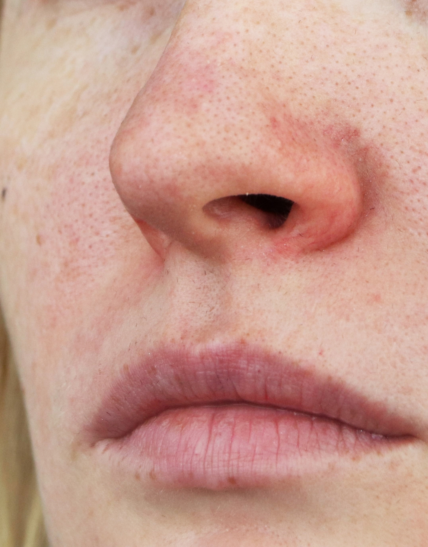 rosacea roedme rosacea rødme næse