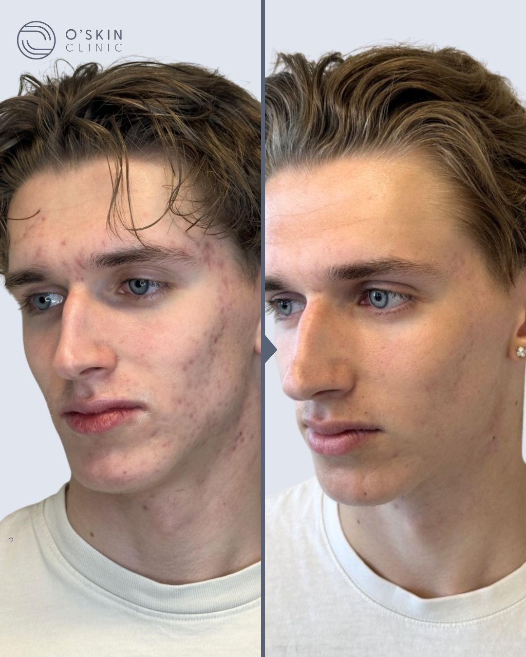 Før og efter Isak Isaks hud for og efter hans skinjourney forløb med aknebehandling