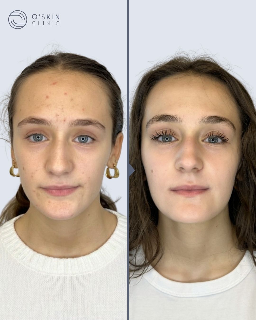 Før og efter-37