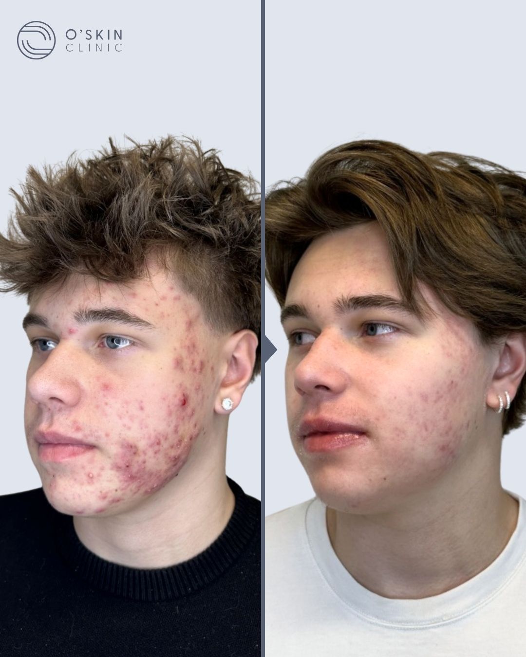 Før og efter Marius Marius før og efter hans SkinJourney forløb. Forløb hos O'Skin Clinic Kolding