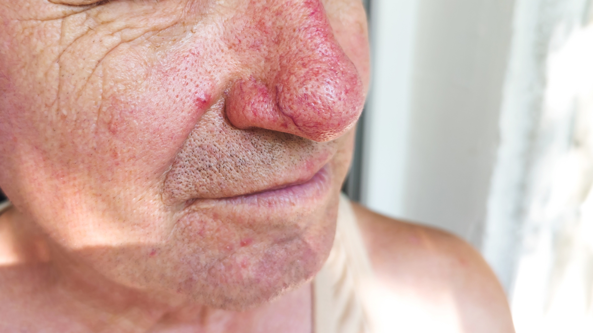 rosacea næse - rhinophyma