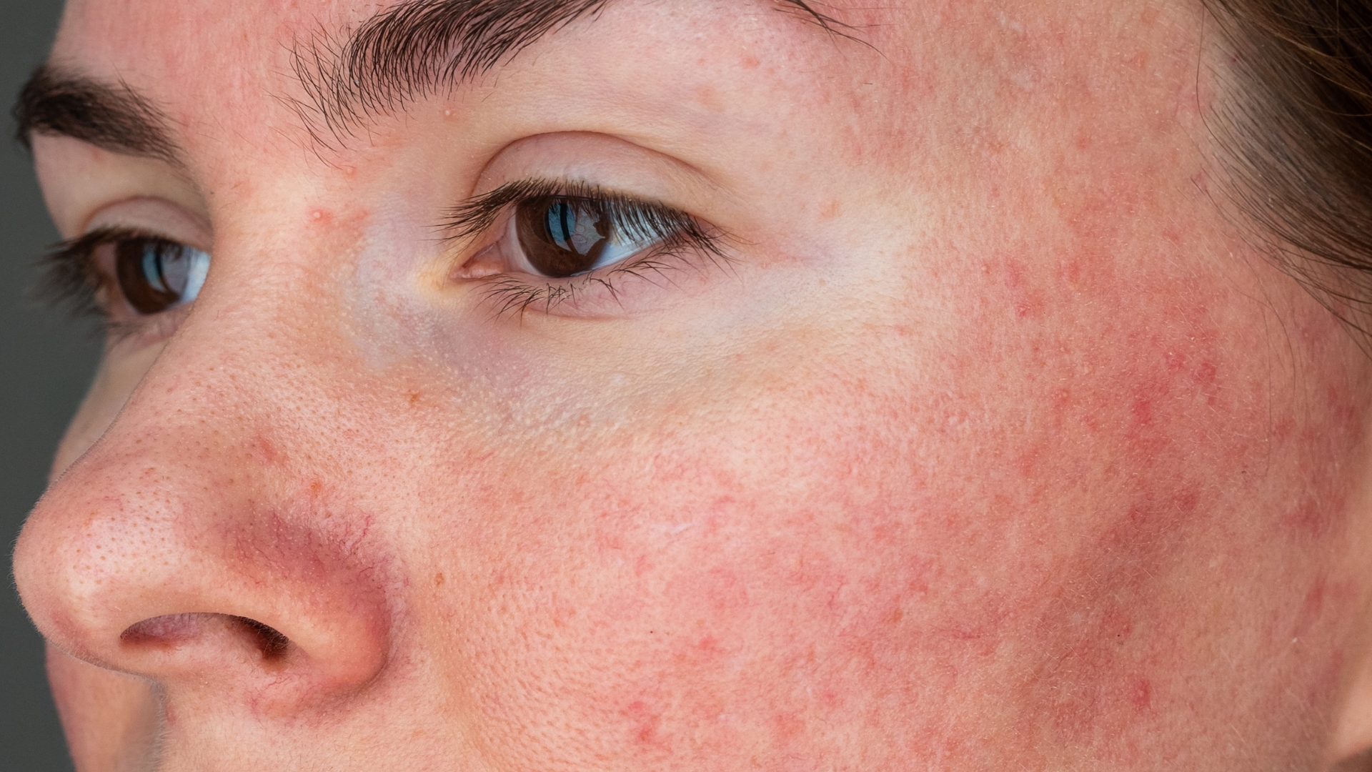 billeder af rosacea