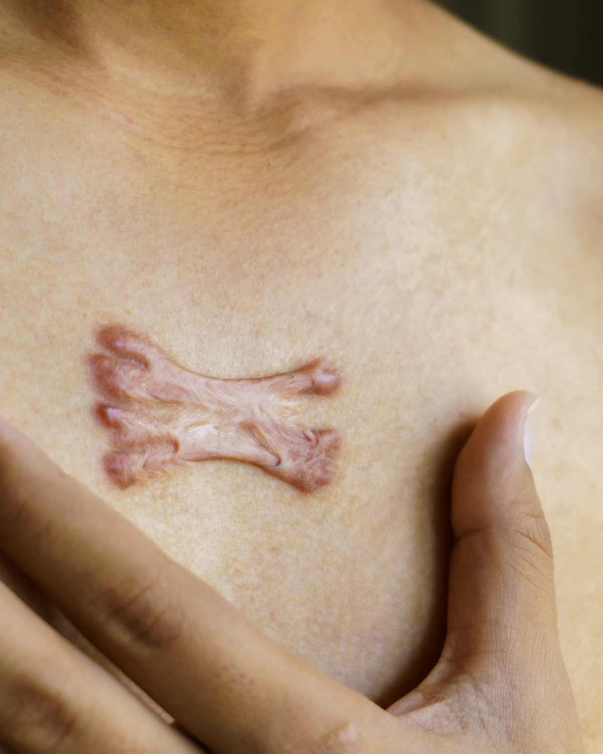 keloid ar