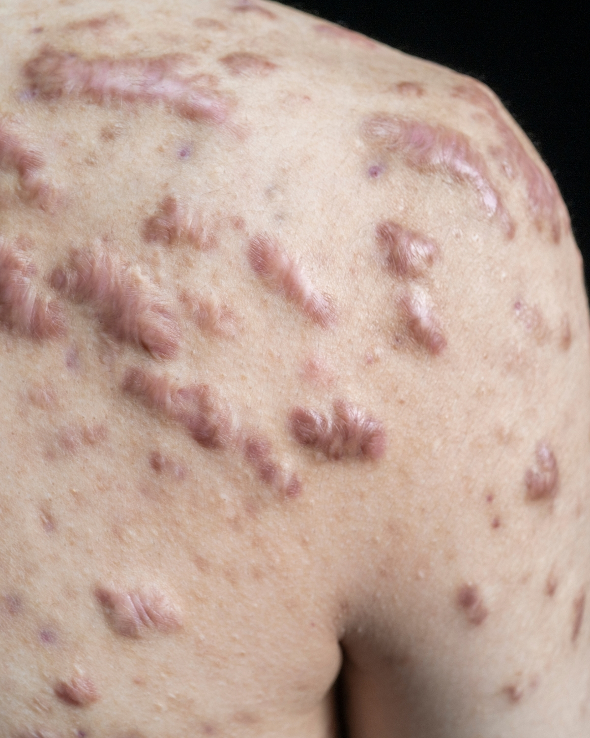 keloid-akne keloid ar after akne